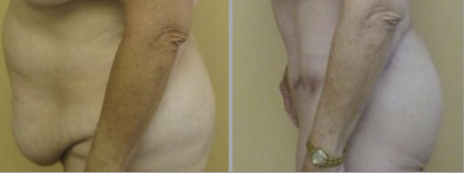 Lower Body Lift in Ventura, CA